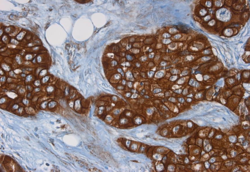 Figure 2. Immunohistochemistry of MUB1319P on formalin fixed, paraffin embedded tissue section of human breast carcinoma. Dilution 1:100.